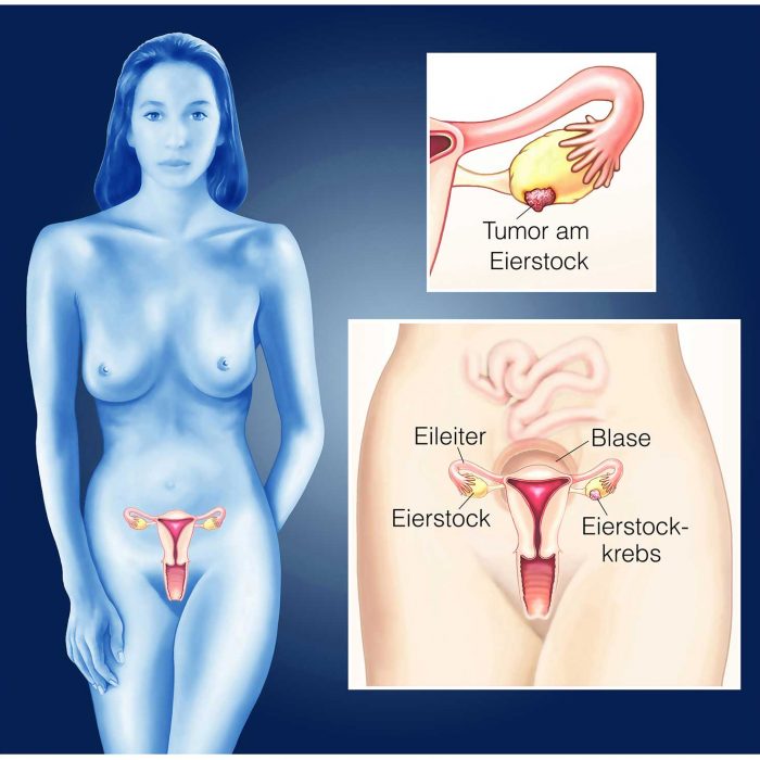 Rak jajnika: celowane terapie skojarzone nadzieją dla chorych