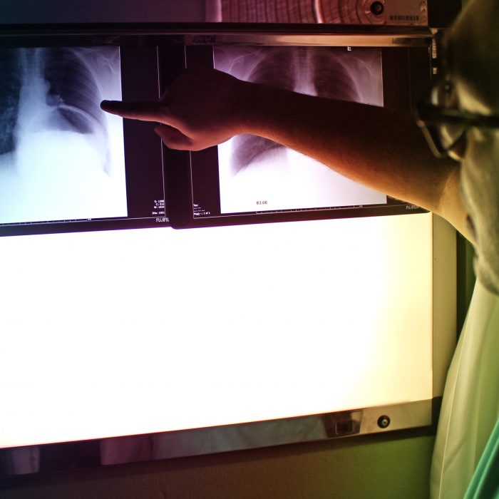 Po raz pierwszy od 40 lat:  nowa terapia w drobnokomórkowym raku płuca