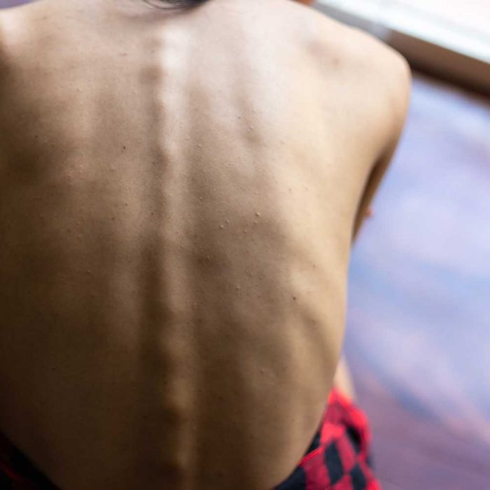 Nowotwór i niedożywienie: nierozłączna para