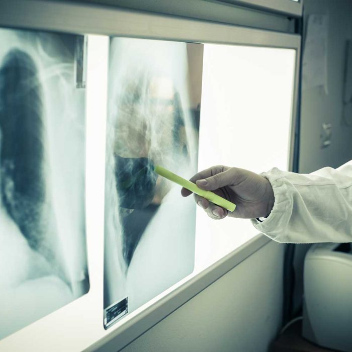 Terapia skojarzona u chorych z NDRP znacząco wydłuża przeżycie