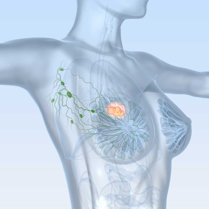 Chemioterapia nie poprawia wyników leczenia wczesnego raka piersi u kobiet po menopauzie￼